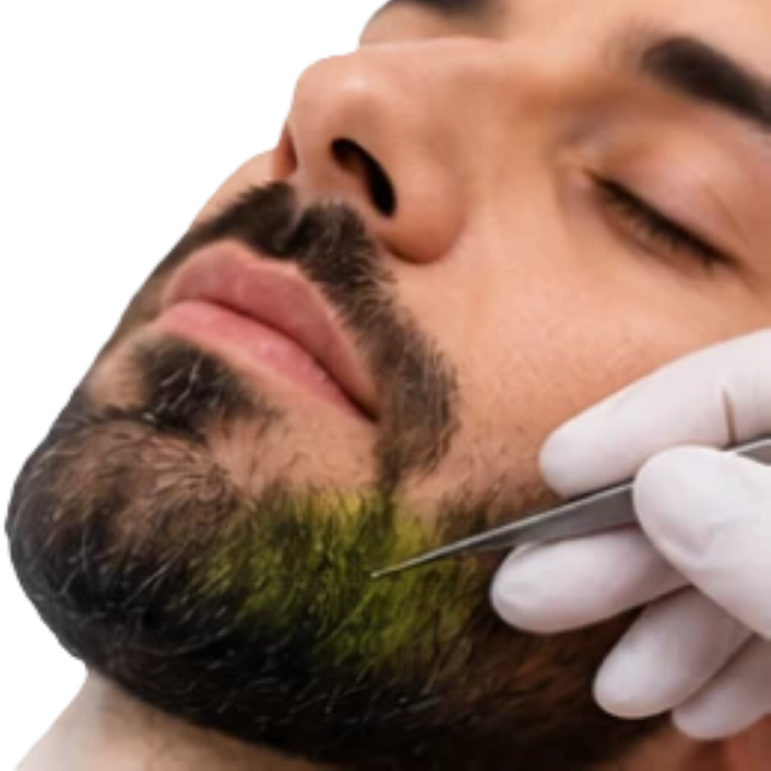 🔹 زراعة اللحية Beard Transplant